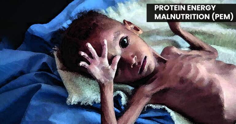 Baby suffering by Protein energy malnutrition